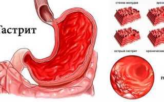 Список лекарств от гастрита желудка
