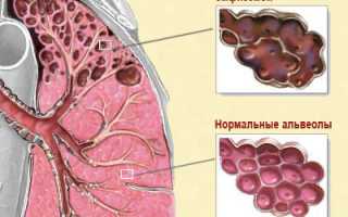 Что такое эмфизема легких?
