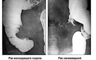 Первые симптомы рака сигмовидной кишки, его лечение