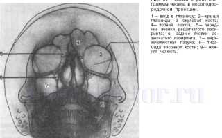 Рентгенография околоносовых пазух — как делается и что показывают рентгенограммы