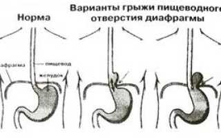 Параэзофагеальная грыжа: чем опасна и как диагностируется