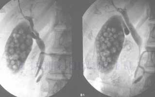 Пероральная холецистография или рентген желчного пузыря — подготовка, показания, последствия