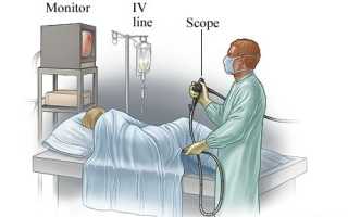 Как очистить кишечник перед колоноскопией