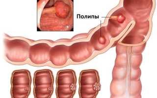 Первые симптомы полипов в прямой кишки, их лечение