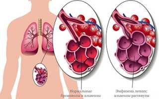 Что такое эмфизема легких?