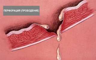 Прободная язва желудка: как развивается, варианты перфораций, диагностика