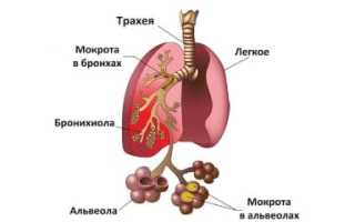 Как можно определить воспаление легких?