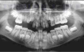 Что видно на рентгеновских снимках челюсти и молочных зубов у детей